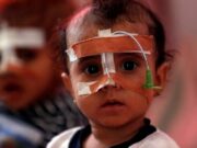Стапка на неухранети деца највисока во Јемен годинава