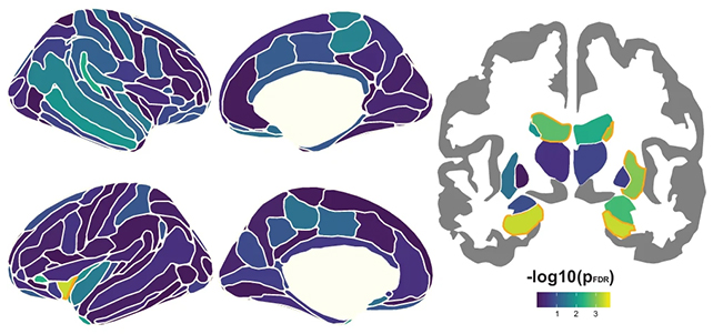 Истражувачите барале врски помеѓу структурните промени во мозокот и падот на меморијата. (Видал-Пињеиро и др., Нат. Комун., 2025)